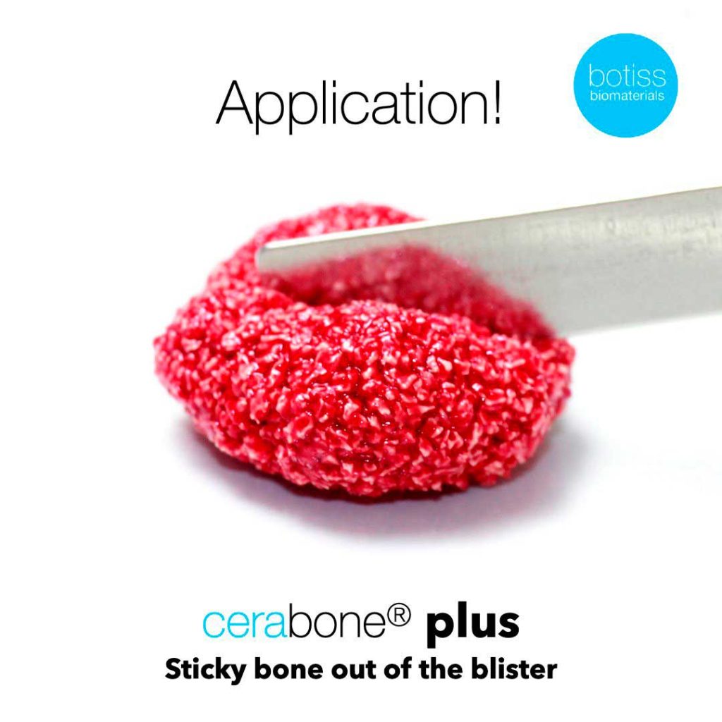 Cerabone® Plus - Innovador Implante de Matriz Ósea Dental