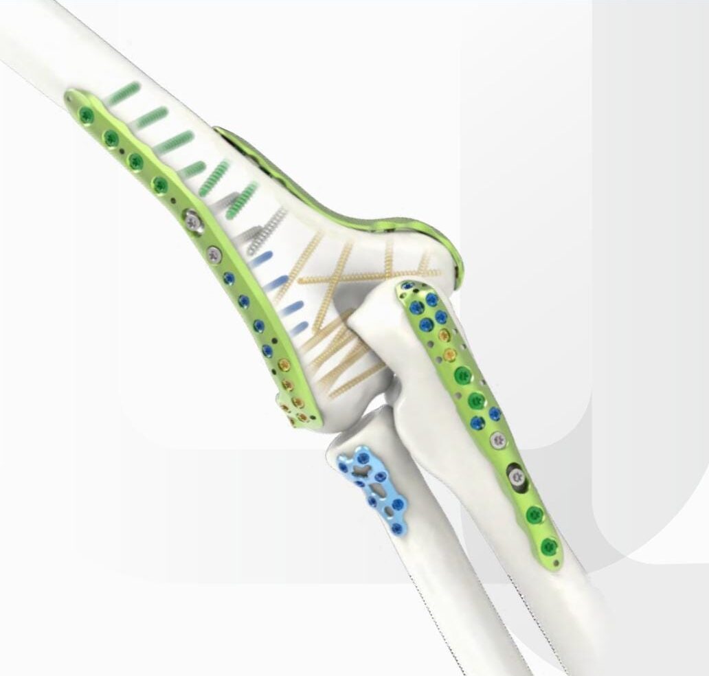 Húmero distal Jeil